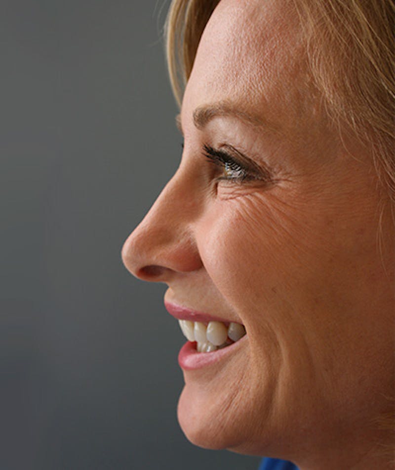 Anti Aging Gallery - Patient 96497762 - Image 4