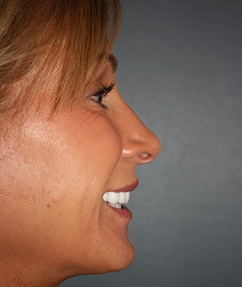 Anti Aging Gallery - Patient 96497762 - Image 5