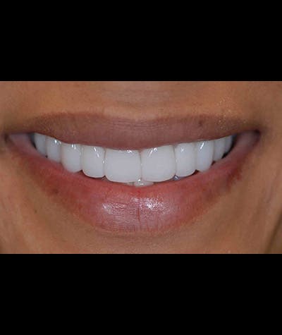 Porcelain Veneers Before & After Gallery - Patient 96870929 - Image 1