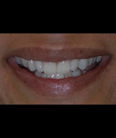 Porcelain Veneers Before & After Gallery - Patient 96870929 - Image 2