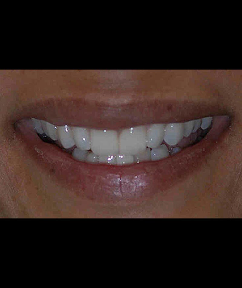 Porcelain Veneers Before & After Gallery - Patient 96870929 - Image 2