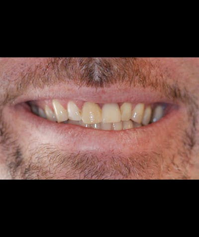 Other Procedures Before & After Gallery - Patient 96497733 - Image 1