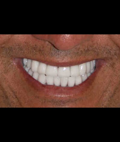 Porcelain Veneers Before & After Gallery - Patient 96870930 - Image 1