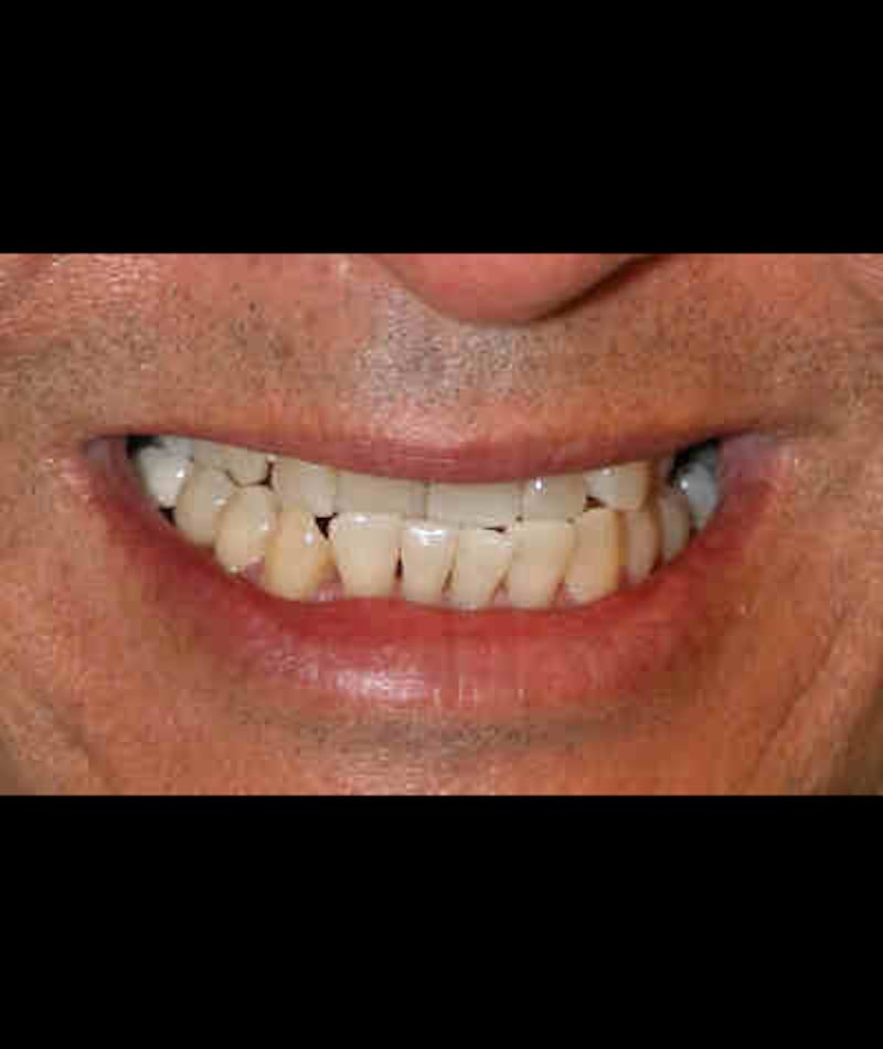 Porcelain Veneers Before & After Gallery - Patient 96870930 - Image 2