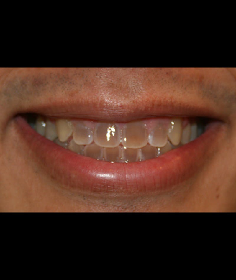 Porcelain Veneers Before & After Gallery - Patient 96870931 - Image 2