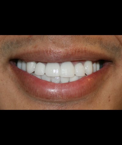 Porcelain Veneers Before & After Gallery - Patient 96870931 - Image 1