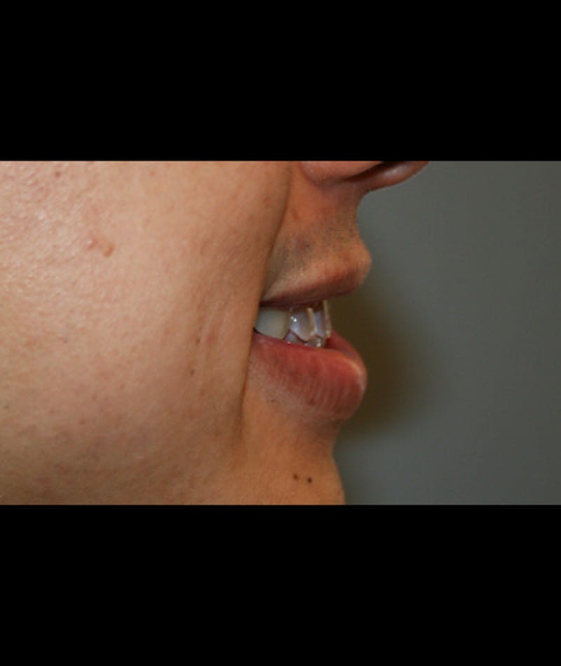 Porcelain Veneers Before & After Gallery - Patient 96870931 - Image 4