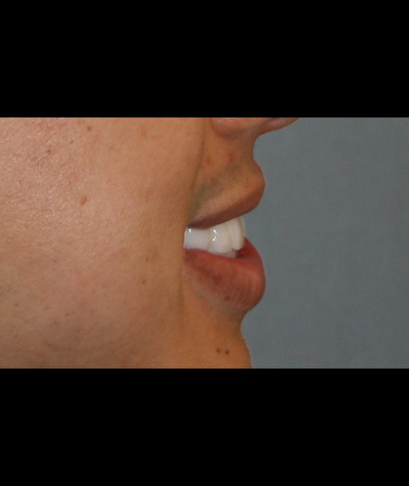 Porcelain Veneers Before & After Gallery - Patient 96870931 - Image 3