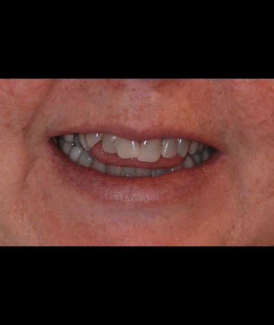 Porcelain Veneers Before & After Gallery - Patient 96870932 - Image 2