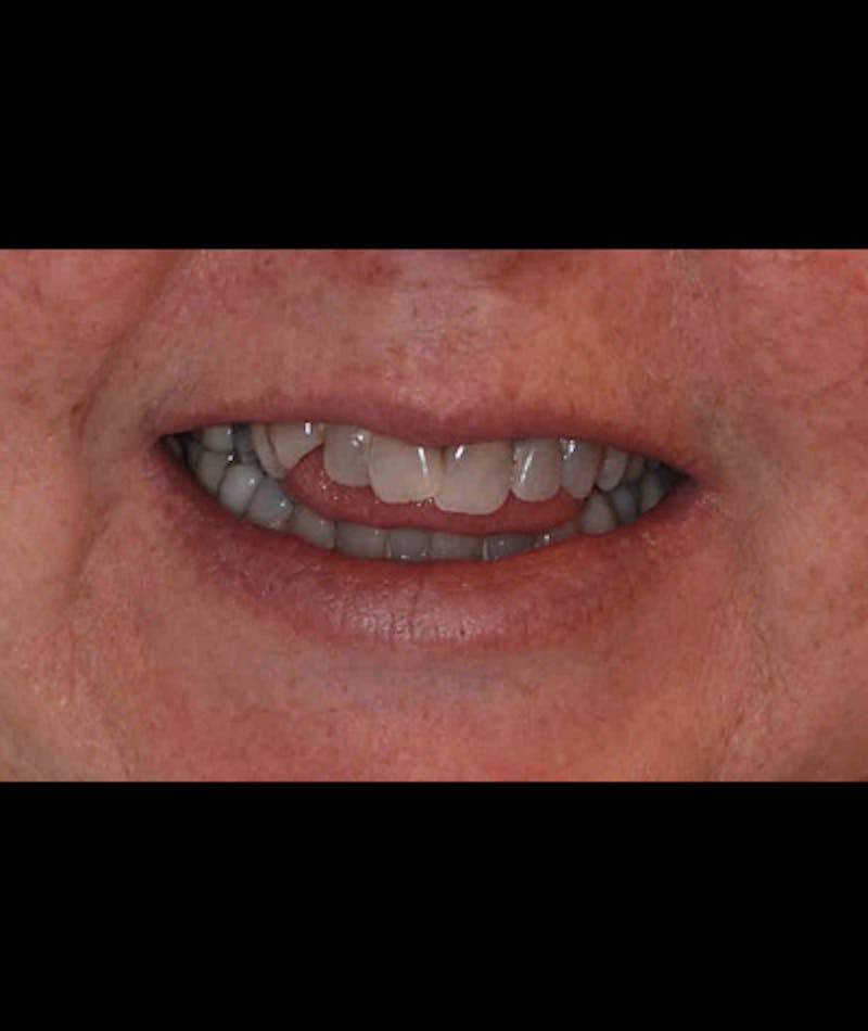 Porcelain Veneers Before & After Gallery - Patient 96870932 - Image 2