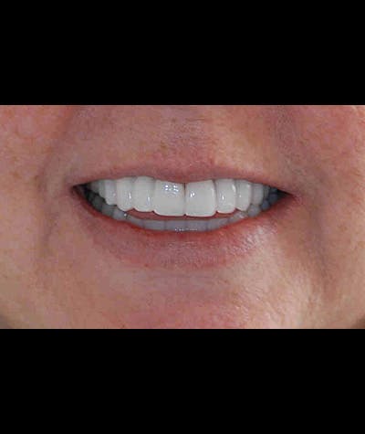 Porcelain Veneers Before & After Gallery - Patient 96870932 - Image 1