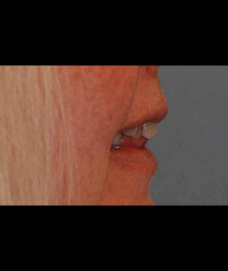 Porcelain Veneers Before & After Gallery - Patient 96870932 - Image 4