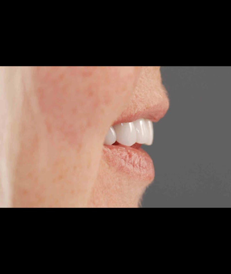 Porcelain Veneers Before & After Gallery - Patient 96870932 - Image 3