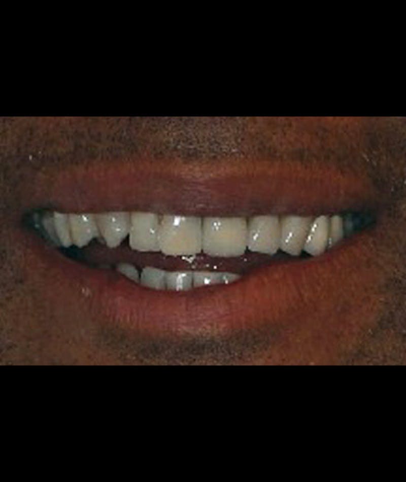 Porcelain Veneers Before & After Gallery - Patient 96870934 - Image 2