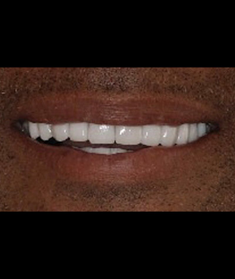 Porcelain Veneers Before & After Gallery - Patient 96870934 - Image 1