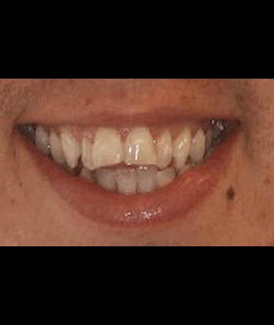 Porcelain Veneers Before & After Gallery - Patient 96871283 - Image 2