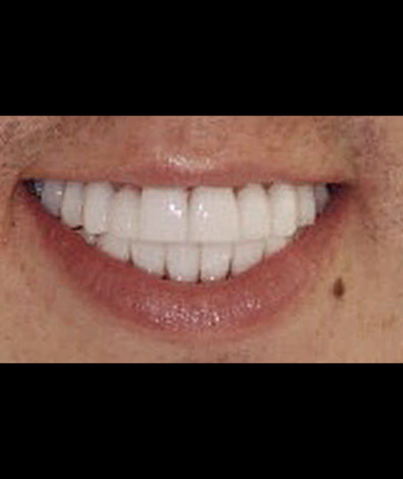 Porcelain Veneers Before & After Gallery - Patient 96871283 - Image 1