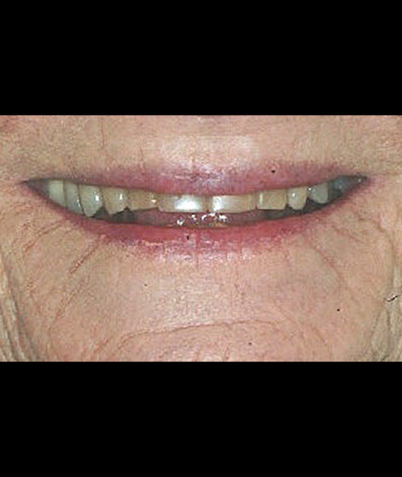 Porcelain Veneers Before & After Gallery - Patient 96871284 - Image 2