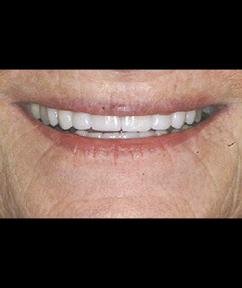 Porcelain Veneers Before & After Gallery - Patient 96871284 - Image 1