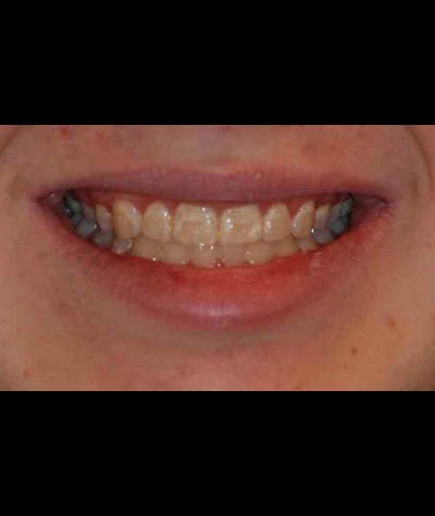 Porcelain Veneers Before & After Gallery - Patient 96871285 - Image 2