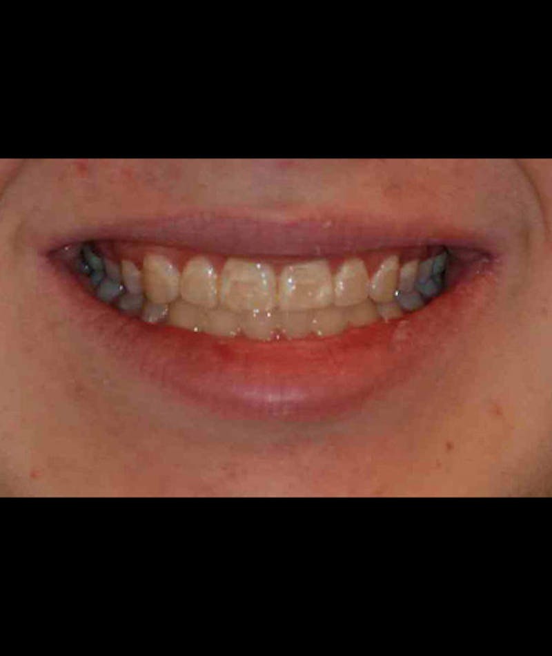 Porcelain Veneers Before & After Gallery - Patient 96871285 - Image 2