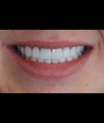 Porcelain Veneers Before & After Gallery - Patient 96871285 - Image 1