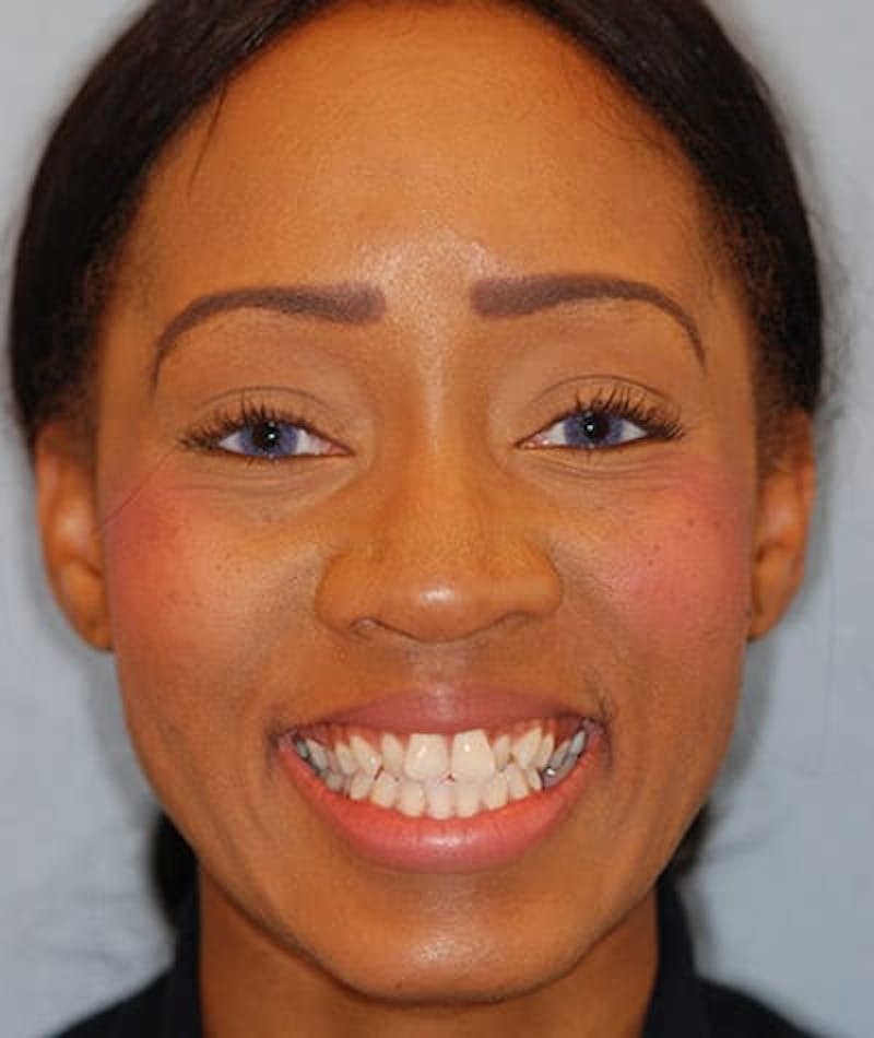 Porcelain Veneers Before & After Gallery - Patient 96871288 - Image 2