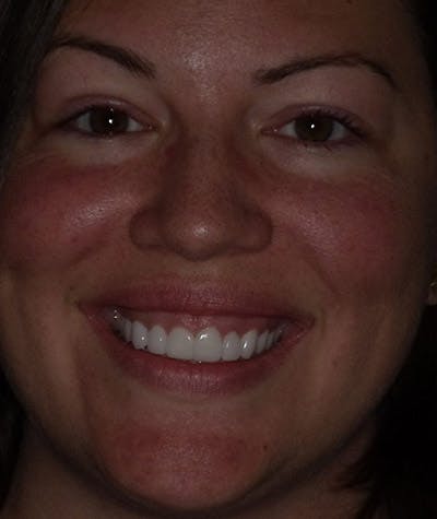 Porcelain Veneers Before & After Gallery - Patient 96905418 - Image 2