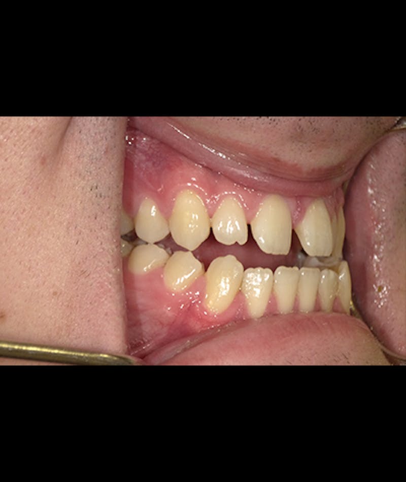 Porcelain Veneers Before & After Gallery - Patient 96905419 - Image 2