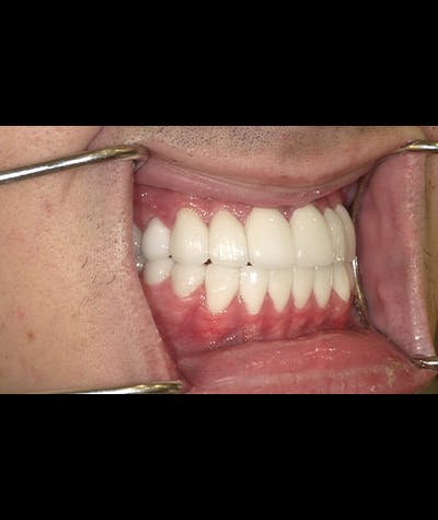 Porcelain Veneers Before & After Gallery - Patient 96905419 - Image 1