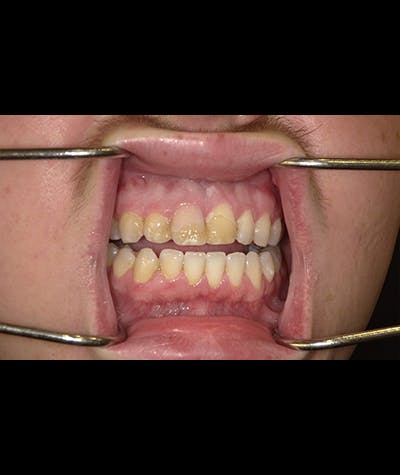 Porcelain Veneers Before & After Gallery - Patient 96905420 - Image 2