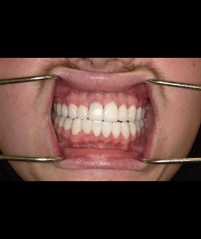 Porcelain Veneers Before & After Gallery - Patient 96905420 - Image 1