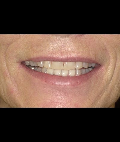 Porcelain Veneers Before & After Gallery - Patient 96905489 - Image 2