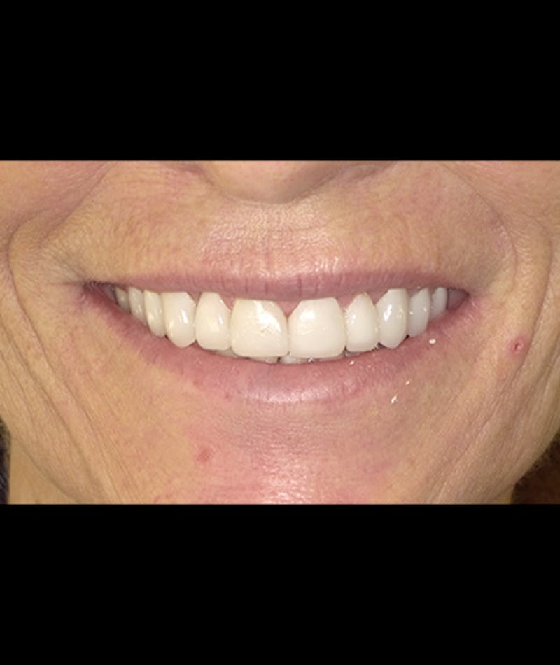 Porcelain Veneers Before & After Gallery - Patient 96905489 - Image 1