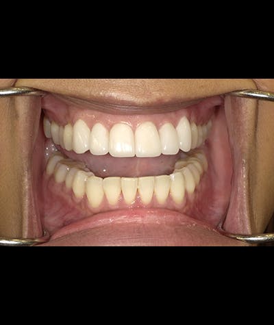 Porcelain Veneers Before & After Gallery - Patient 96905490 - Image 1