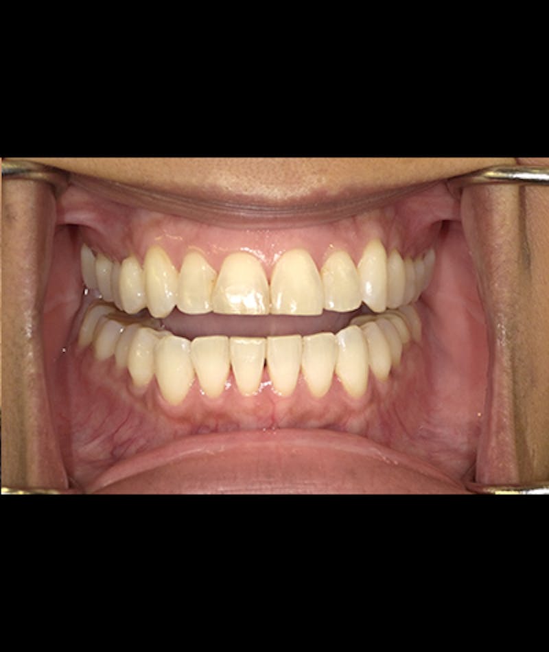 Porcelain Veneers Before & After Gallery - Patient 96905490 - Image 2