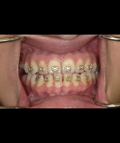 Porcelain Veneers Before & After Gallery - Patient 96905491 - Image 2