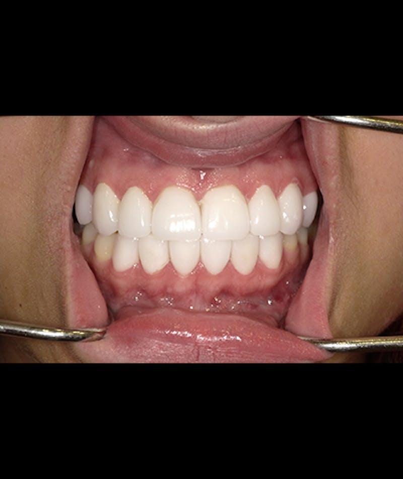 Porcelain Veneers Before & After Gallery - Patient 96905491 - Image 1