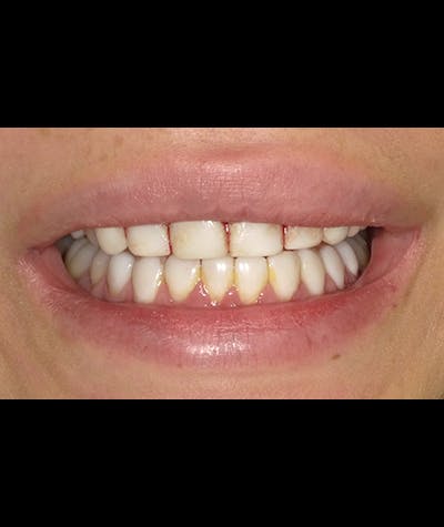 Porcelain Veneers Before & After Gallery - Patient 96905492 - Image 2