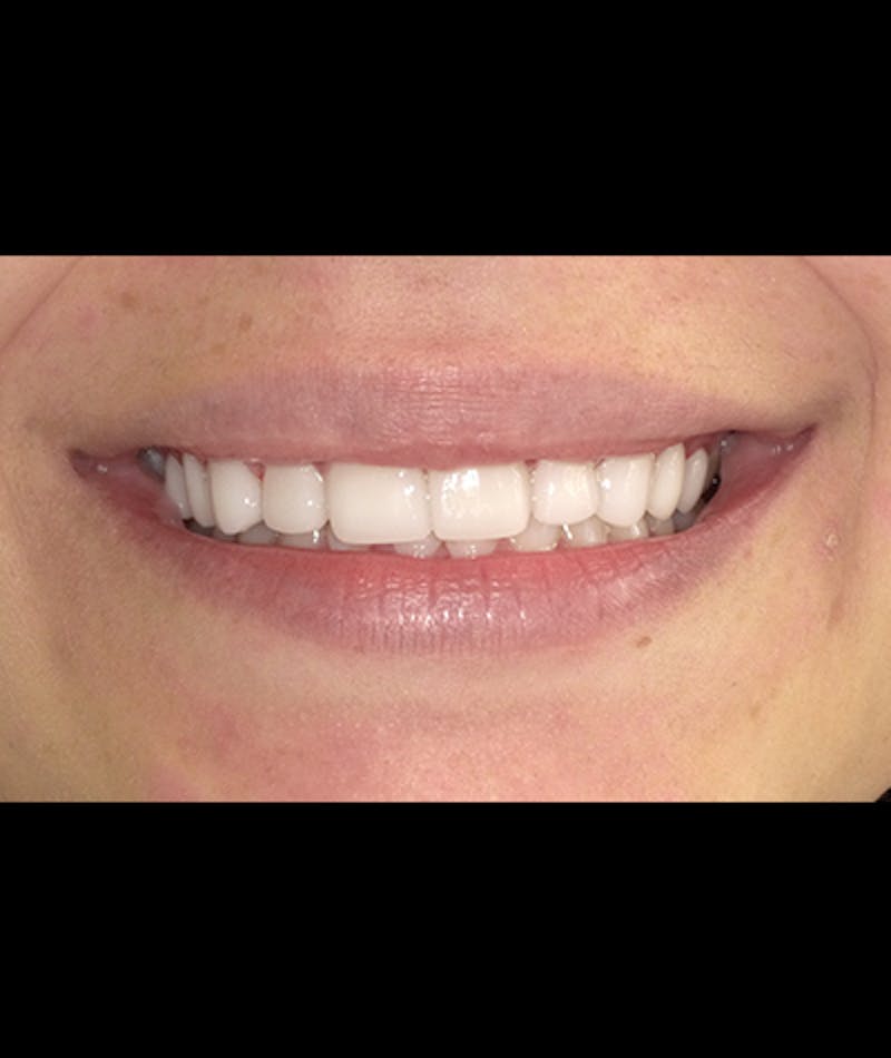 Porcelain Veneers Before & After Gallery - Patient 96905492 - Image 1