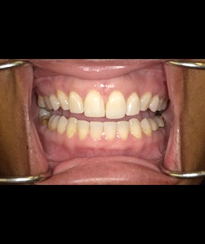 Porcelain Veneers Before & After Gallery - Patient 96905493 - Image 2