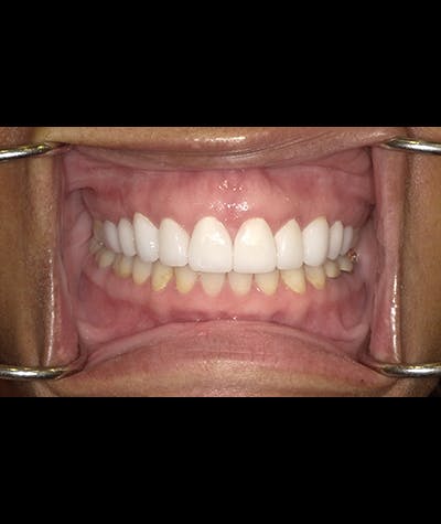 Porcelain Veneers Before & After Gallery - Patient 96905493 - Image 1