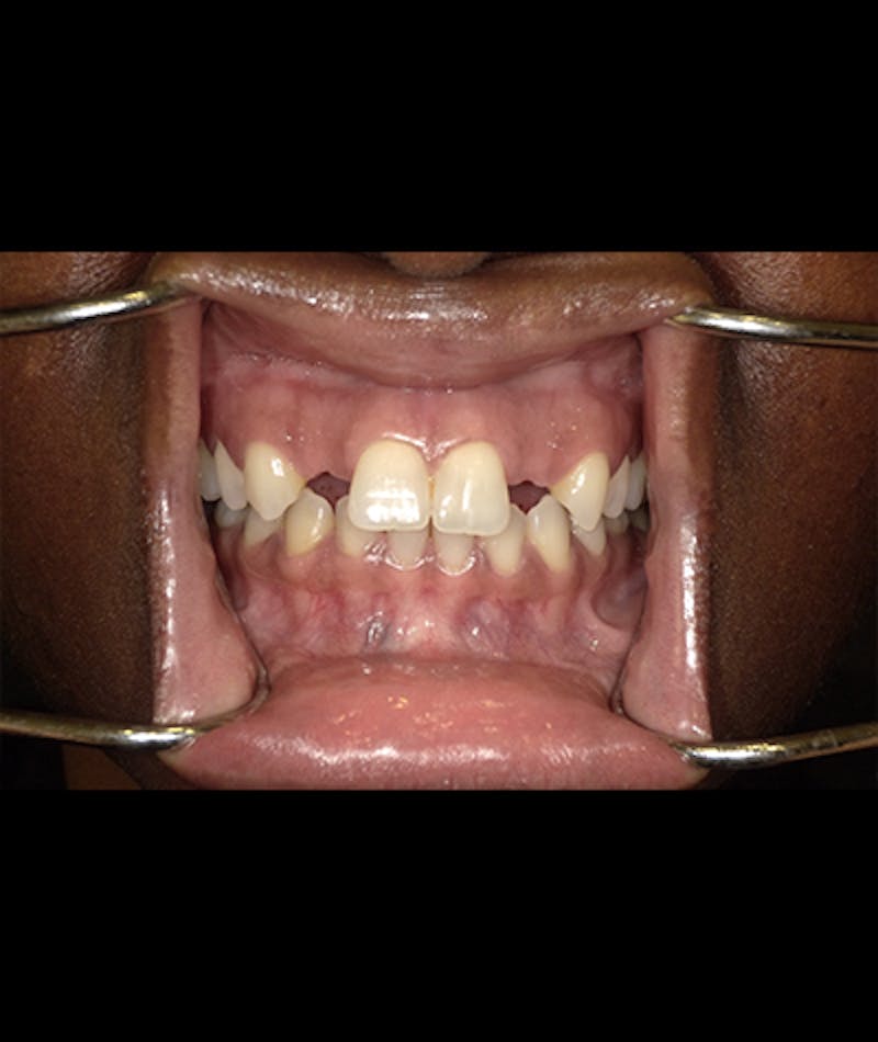 Porcelain Veneers Before & After Gallery - Patient 96909641 - Image 2