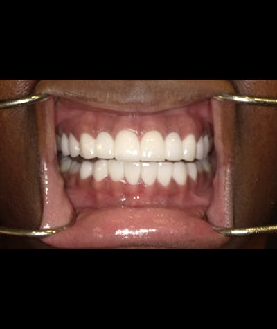 Porcelain Veneers Before & After Gallery - Patient 96909641 - Image 1