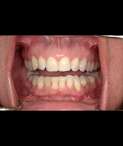 Porcelain Veneers Before & After Gallery - Patient 96909640 - Image 2