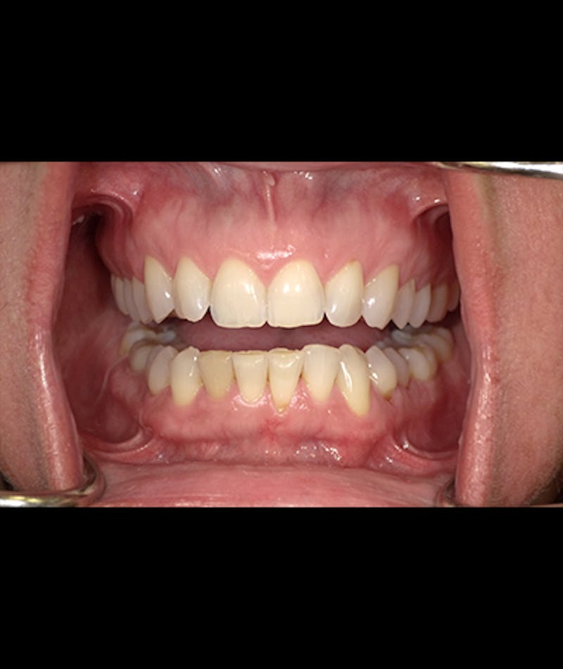 Porcelain Veneers Before & After Gallery - Patient 96909640 - Image 2