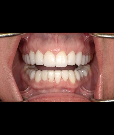 Porcelain Veneers Before & After Gallery - Patient 96909640 - Image 1