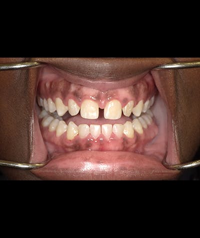 Porcelain Veneers Before & After Gallery - Patient 96909642 - Image 2