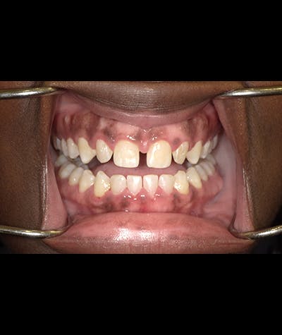 Porcelain Veneers Before & After Gallery - Patient 96909642 - Image 2