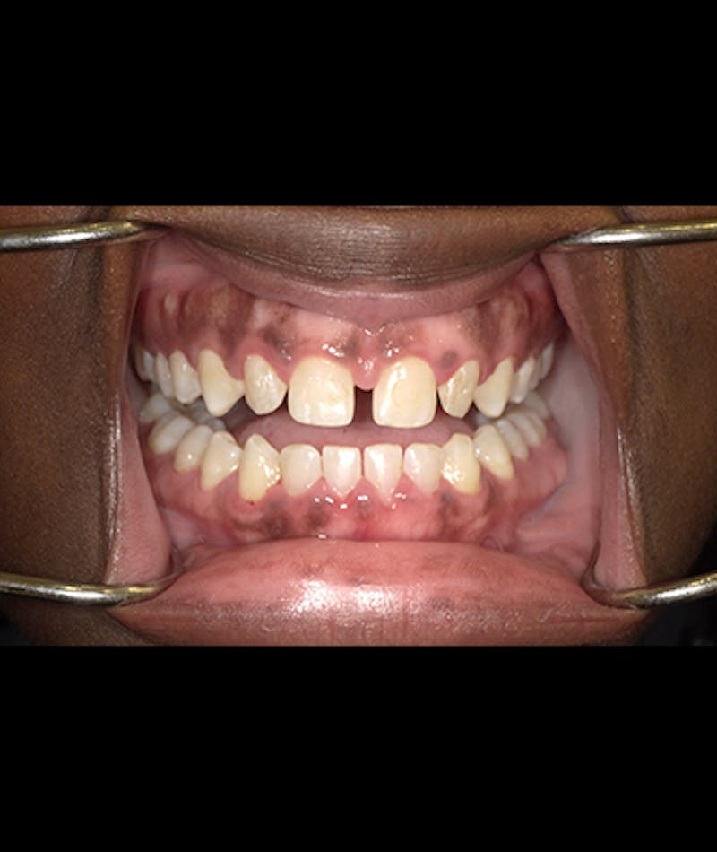 Porcelain Veneers Before & After Gallery - Patient 96909642 - Image 2